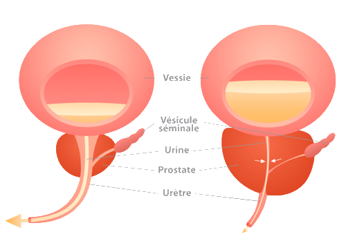 Diff&eacute;rence entre une prostate normale et une prostate hypertrophi&eacute;e
